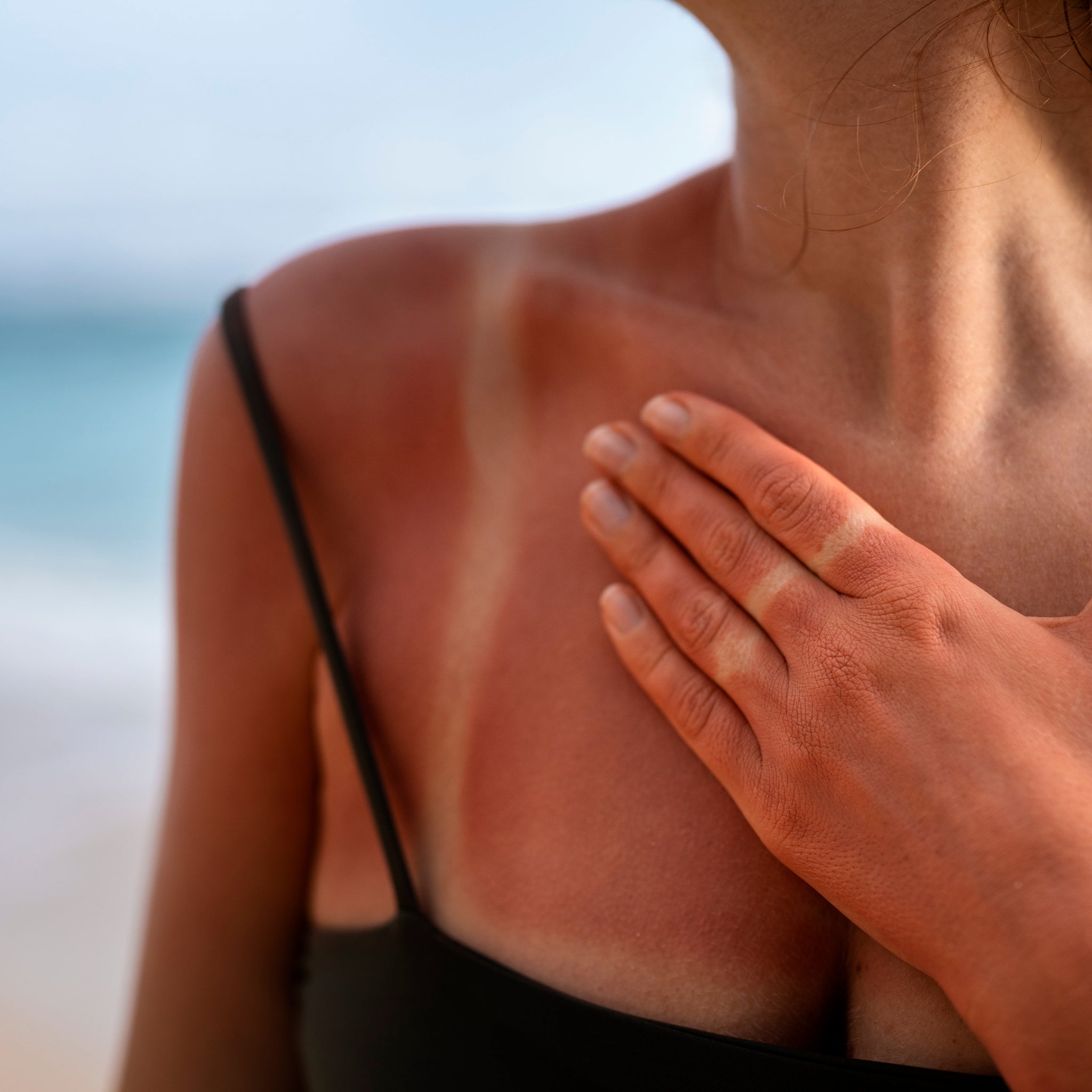 How to Recover from Summer Burns and Photosensitivity with Natural Moroccan Oils